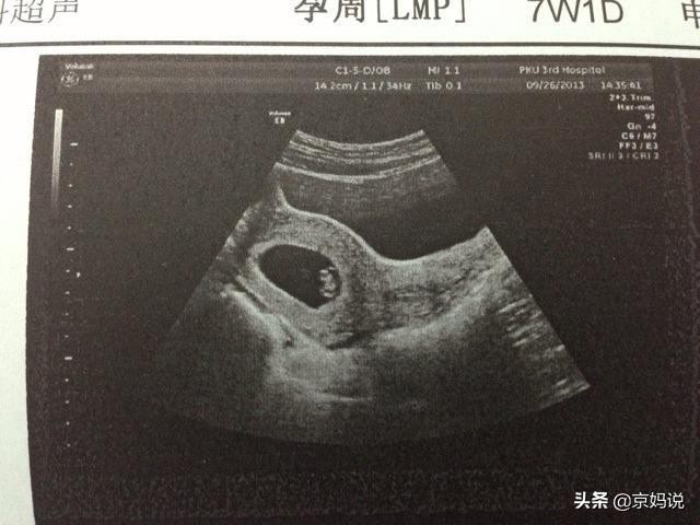 胎停和怀男怀女有关系吗