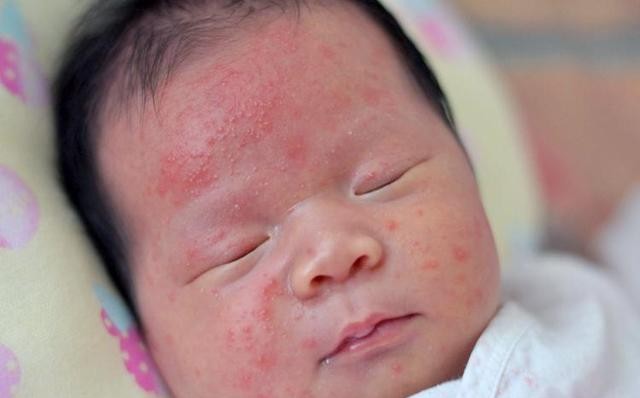 孕晚期需要去胎毒吗