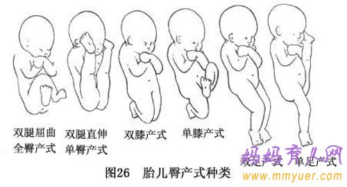 造成胎儿臀位的原因以及危害 三招帮你转正胎位