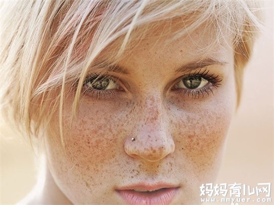 雀斑真的会遗传 关于雀斑遗传的那些知识妈妈要知道