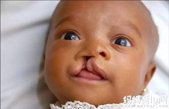 畸形胎儿比例上升 在哪些情况下会导致胎儿畸形