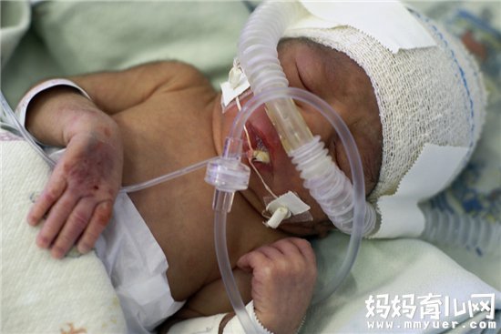 早产危害大 这几类孕妇要注意早产情况产生