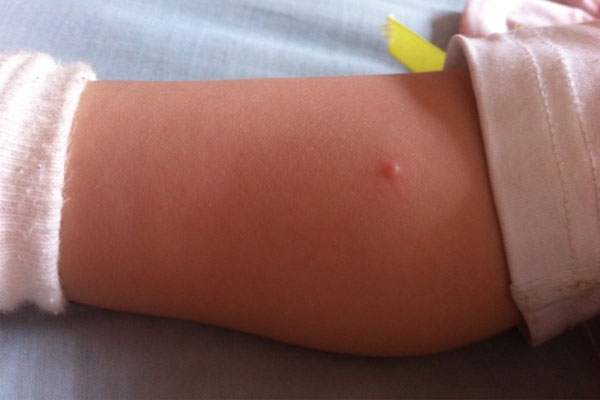 宝宝出水痘几天能好？出现水痘怎么治疗