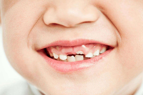 儿童乳牙换牙顺序有规律,怎么换、什么时候换家长别迷糊