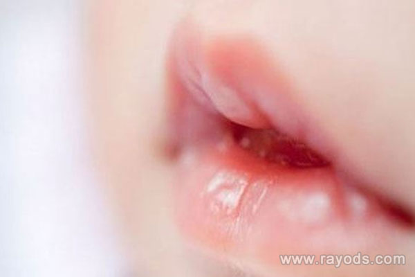 快速恢复婴儿嘴唇裂口三个小妙招