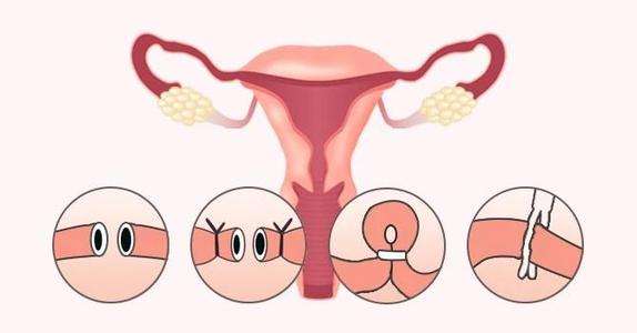 双侧输卵管结扎可以复通吗（结扎后复通手术痛苦吗）