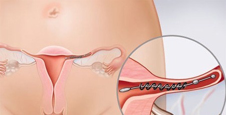 宫外孕多久开始腹痛出血块（宫外孕多少天会有症状）
