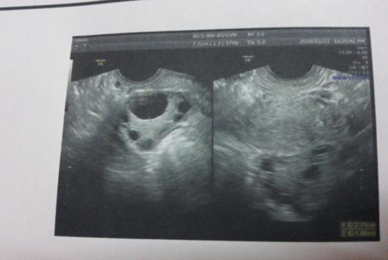 卵泡长得慢吃黑豆跳绳 来看看网友的自述经历