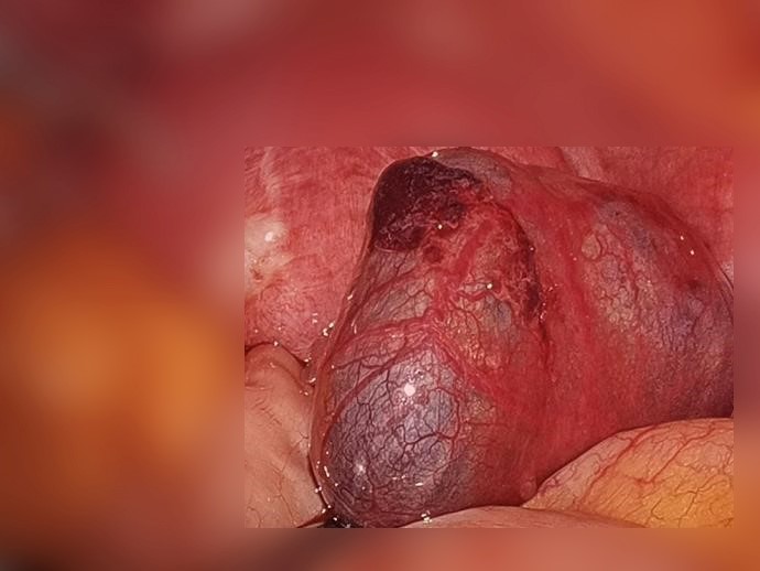 “月经”变少“痛经”加剧，没想到竟查出宫外孕？