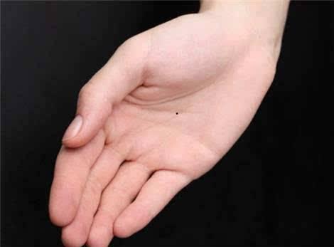 手心里有长红痣黑痣代表什么 手心有痣好不好