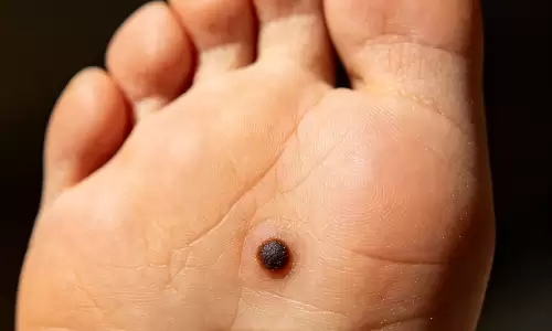 脚下有痣详解，看懂你的天生运势