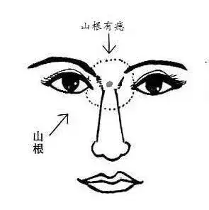 山根处痣的性格与命运解读