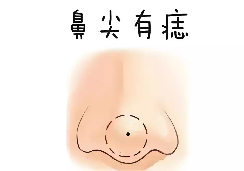 鼻尖有痣代表什么？面相学解析财运与健康运势