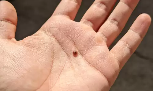 手掌有痣的人，晚年都不简单