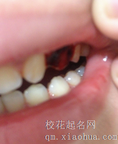 孕妇梦见自己掉牙流血