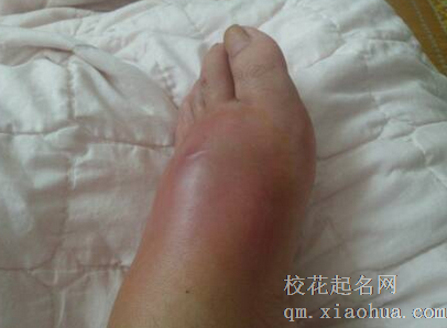 梦见自己的脚红肿