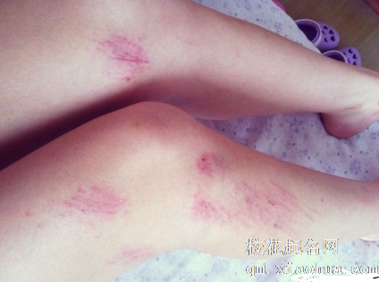 梦见自己腿流血