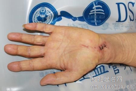 梦见手腕开刀周公解梦，梦见手腕开刀是什么意思？