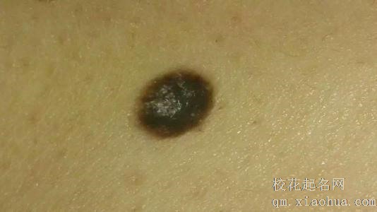 梦见黑痣周公解梦，梦见黑痣是什么意思？