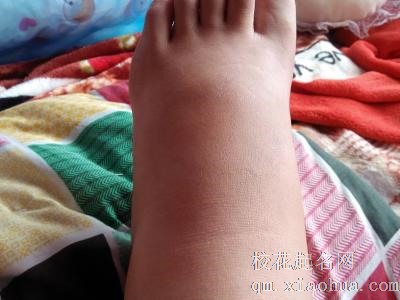 梦见脚肿周公解梦，梦见脚肿是什么意思？