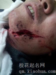 梦见颧骨或下颚断裂周公解梦，梦见颧骨或下颚断裂是什么意思？