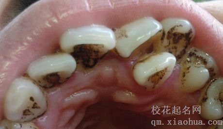 梦见牙齿黑了周公解梦，梦见牙齿黑了是什么意思？